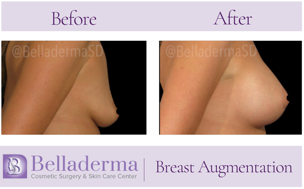 Breast Augmentation Before and After