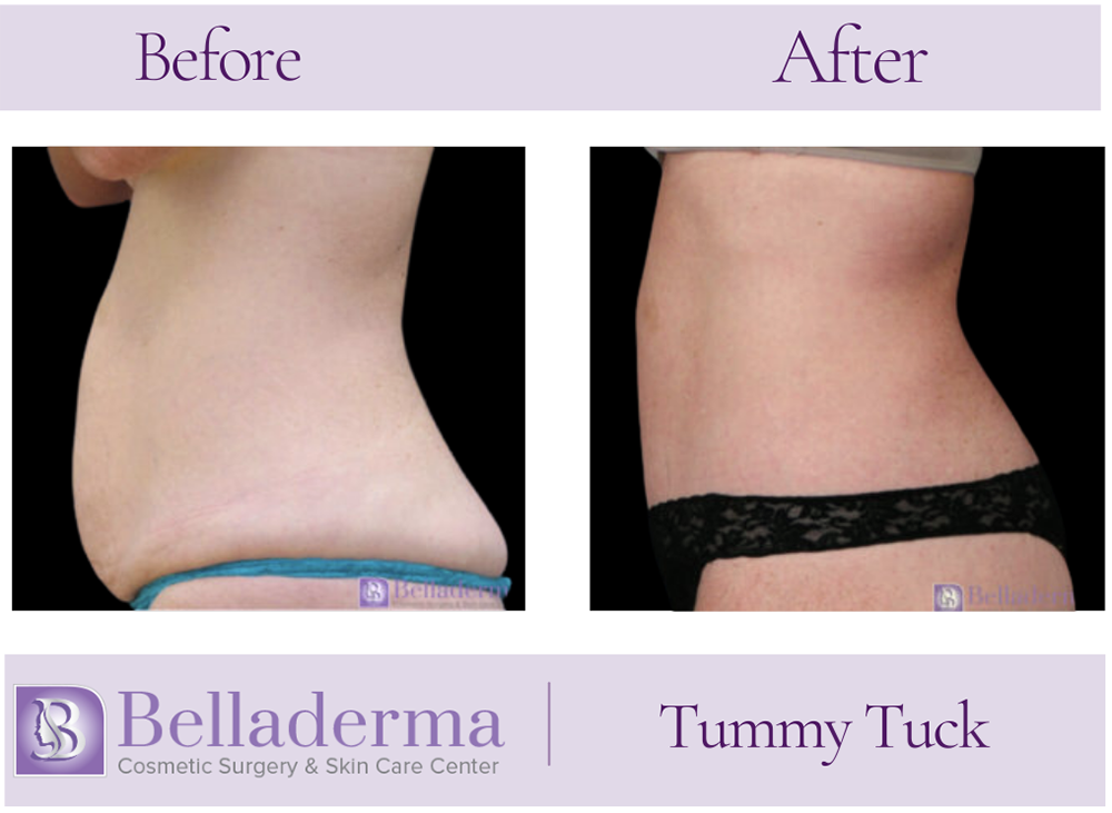 Tummy Tuck (abdominoplasty) Before and After