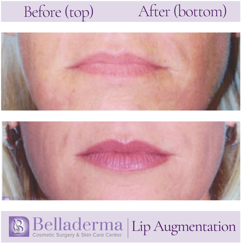 Lip Augmentation Before and After