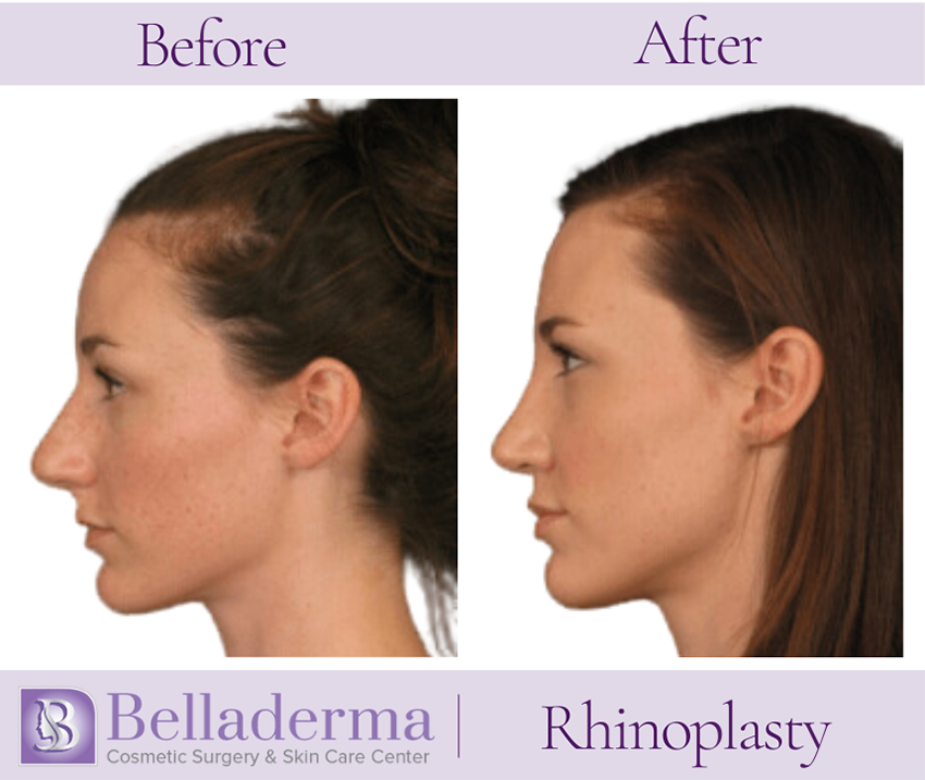 Rhinoplasty Before and After