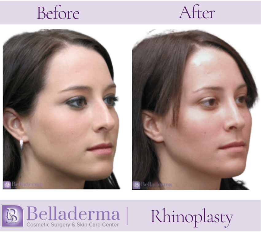 Rhinoplasty Before and After