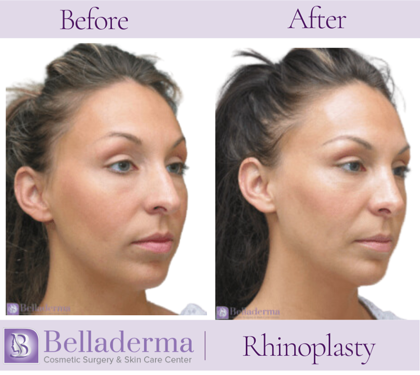 Rhinoplasty Before and After