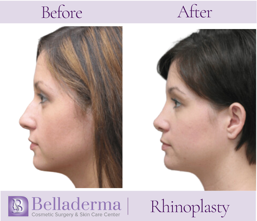 Rhinoplasty Before and After