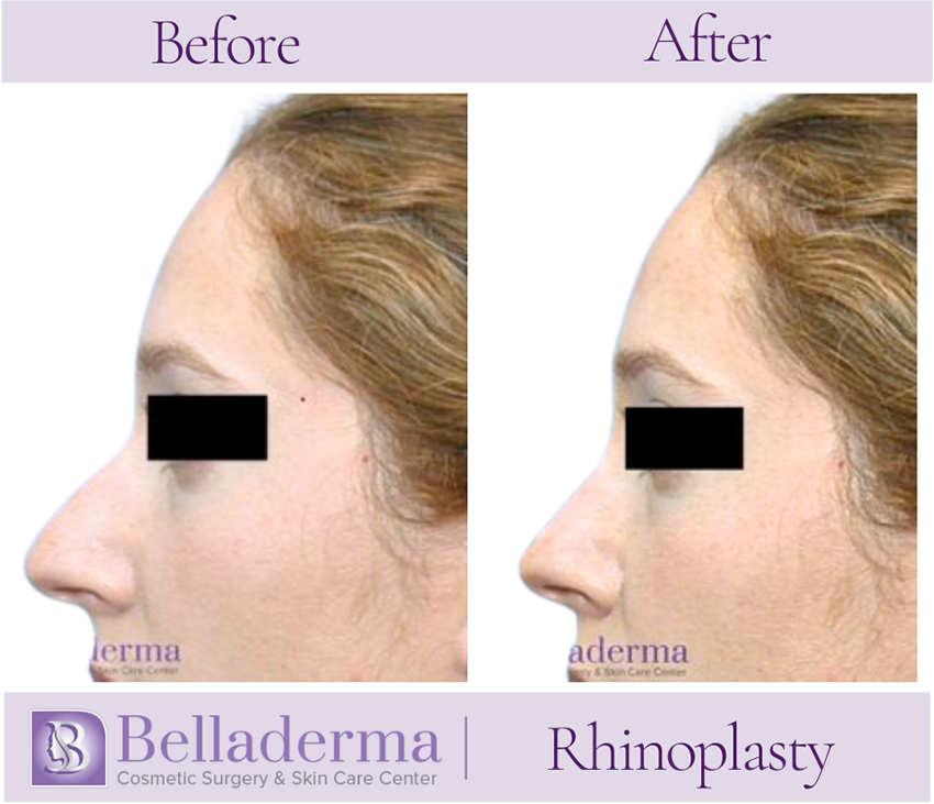 Rhinoplasty Before and After