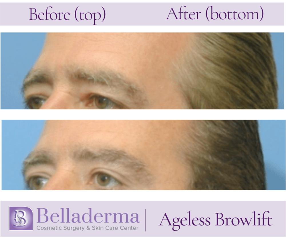 Brow Lift and Eyelid Lift Before and After