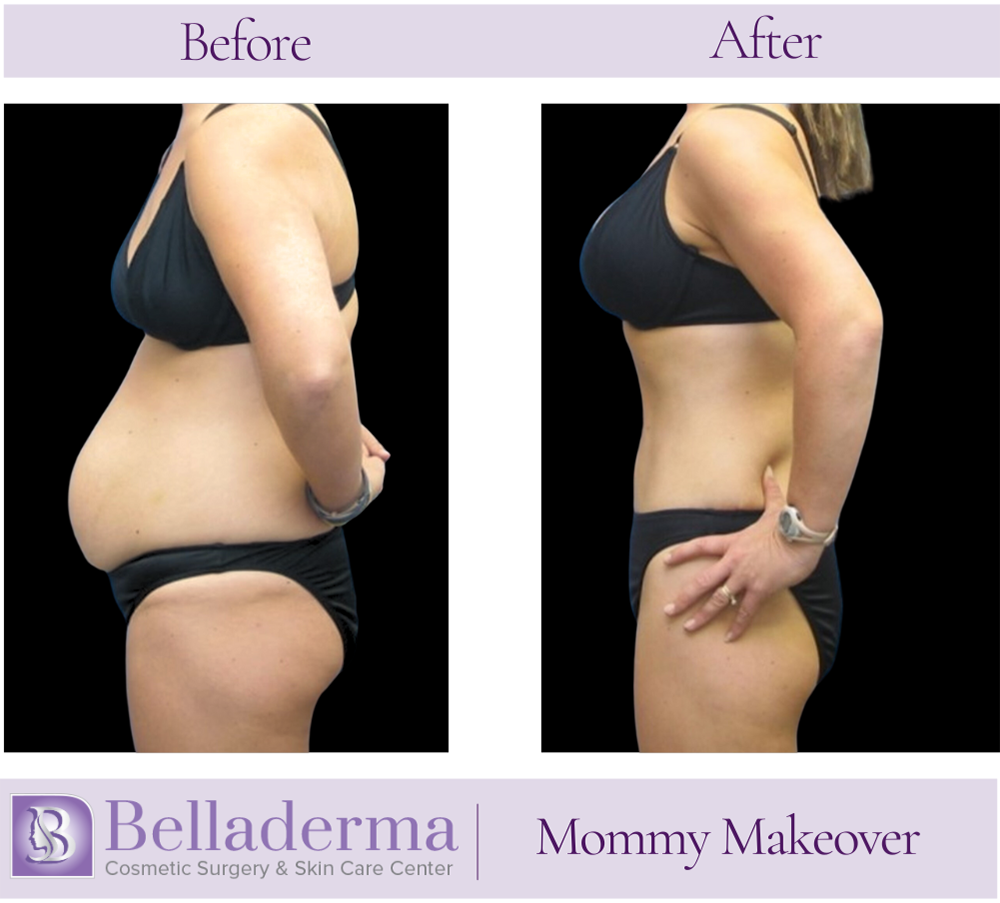 6 Mommy Makeover Before and After