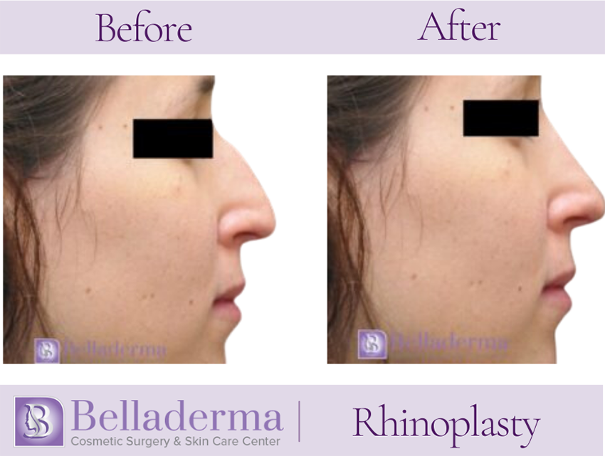 Rhinoplasty Before and After