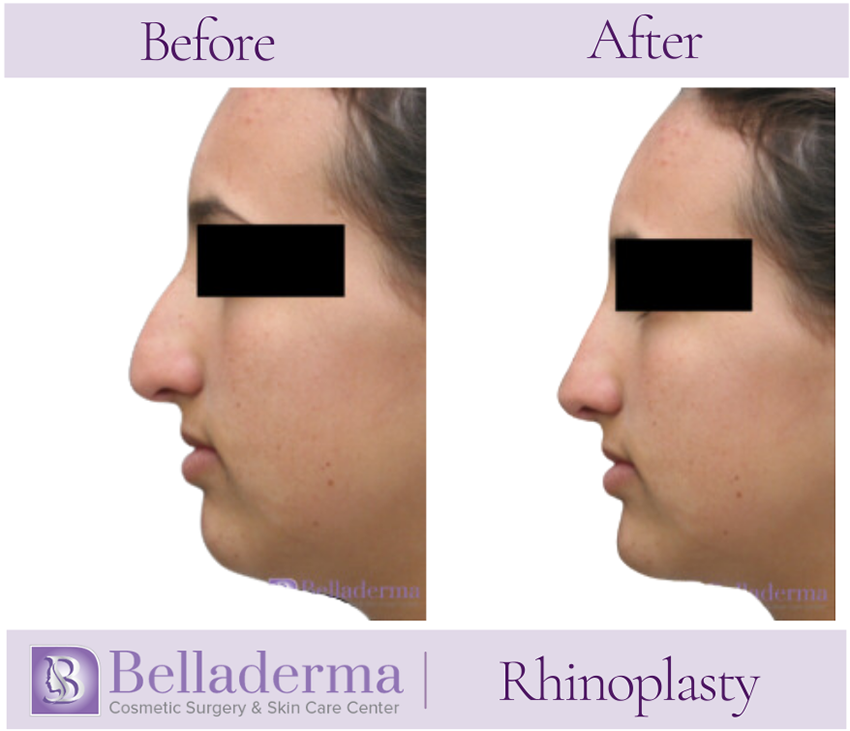 Rhinoplasty Before and After