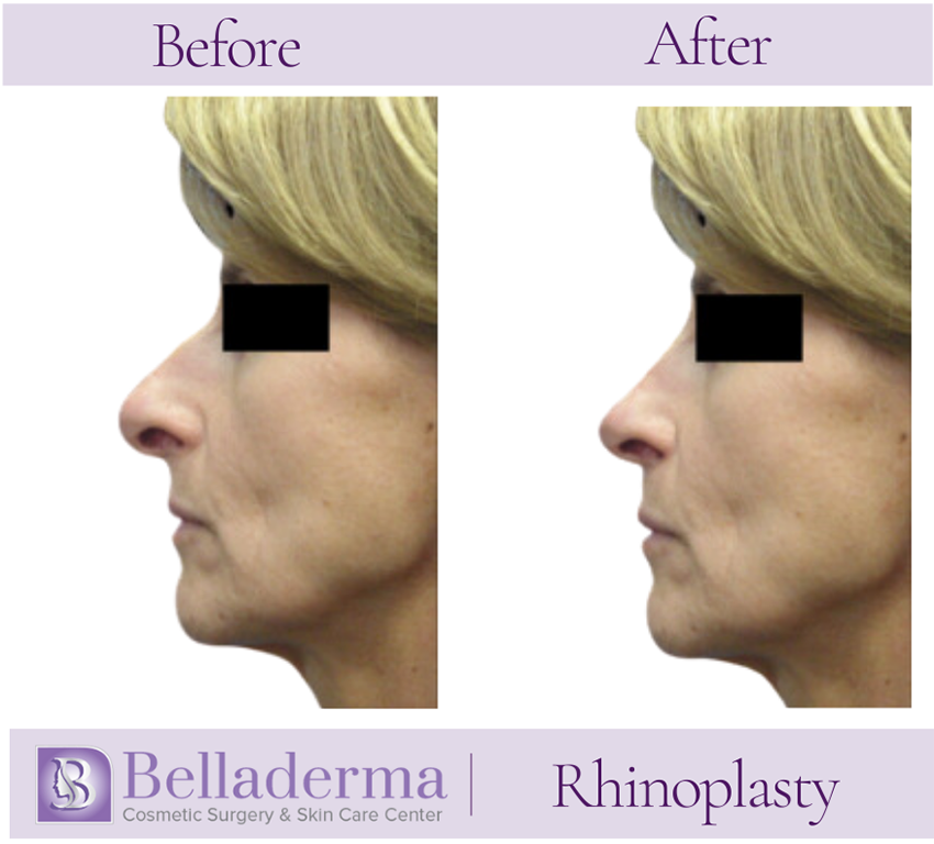 Rhinoplasty Before and After