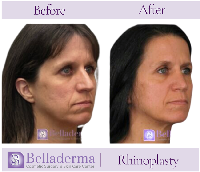 Rhinoplasty Before and After