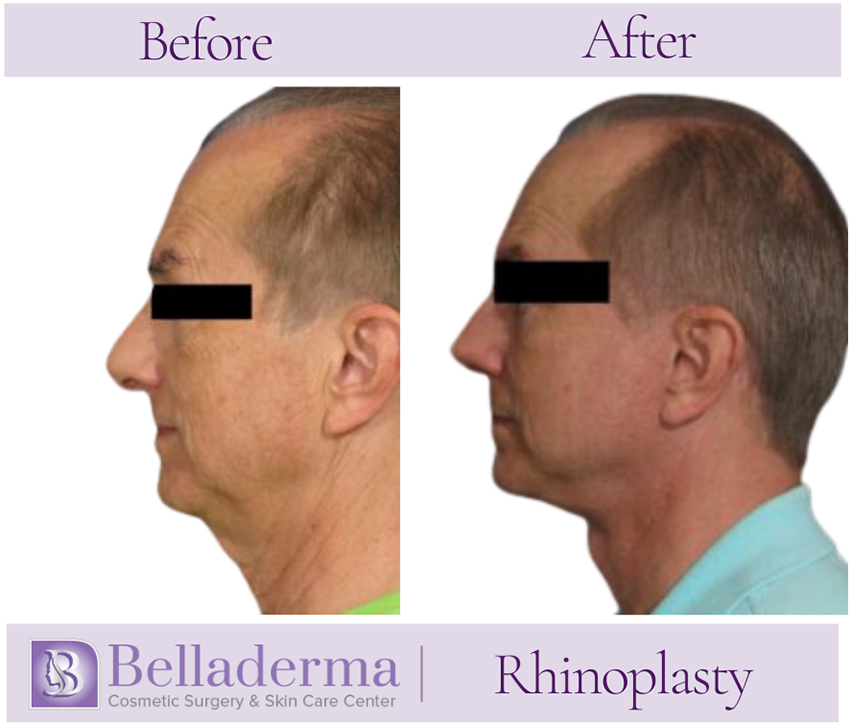 Rhinoplasty Before and After