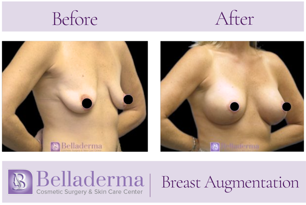 Breast Augmentation Before and After