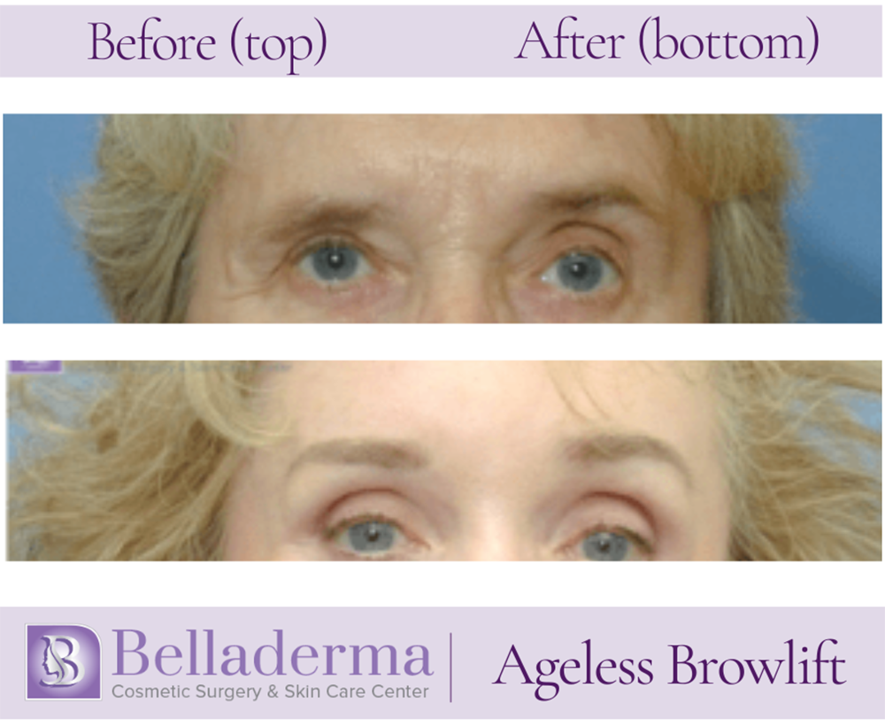 Brow Lift and Eyelid Lift Before and After