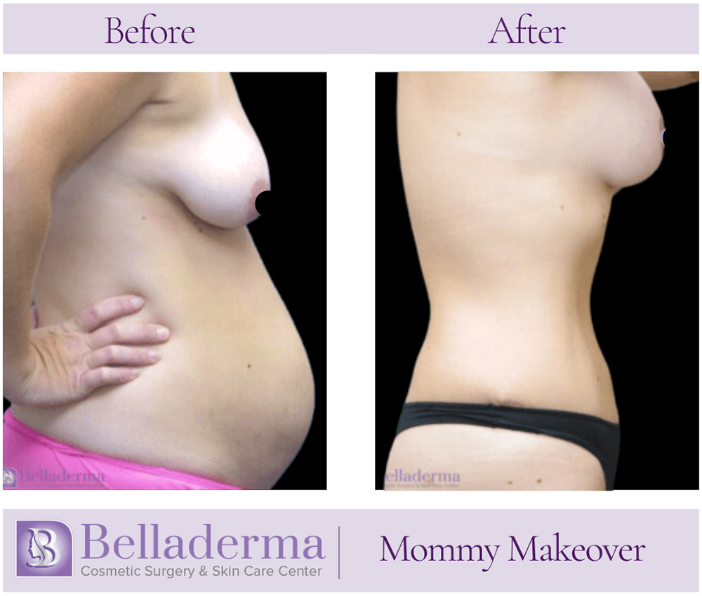 7 Mommy Makeover Before and After