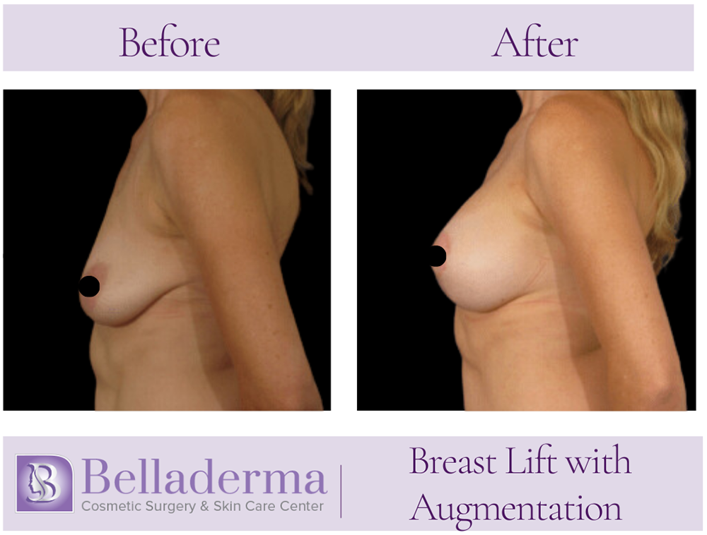 74 Breast Augmentation with Lift Before and After Photos