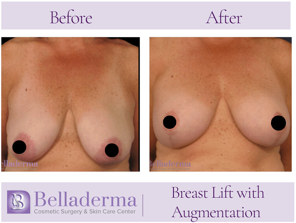 Breast Augmentation with Lift Before and After Photos