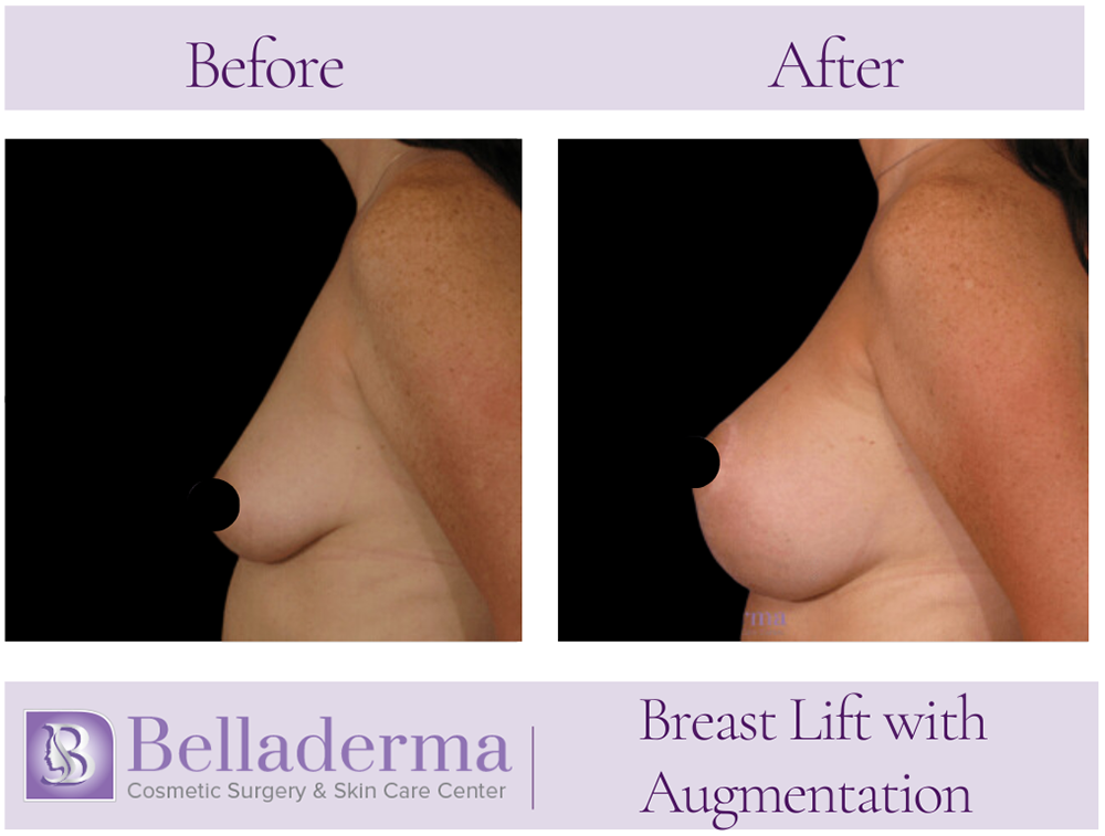 Breast Augmentation with Lift Before and After Photos