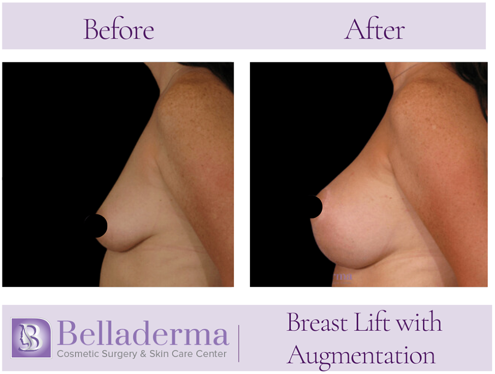 76 Breast Augmentation with Lift Before and After Photos