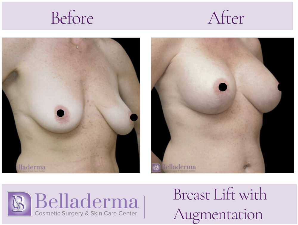 Breast Augmentation with Lift Before and After Photos