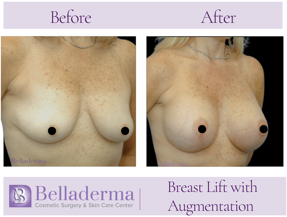 Breast Augmentation with Lift Before and After Photos