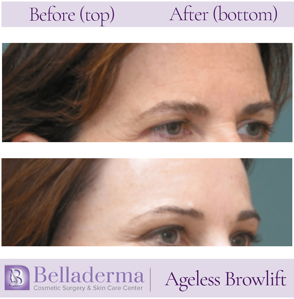 Brow Lift and Eyelid Lift Before and After