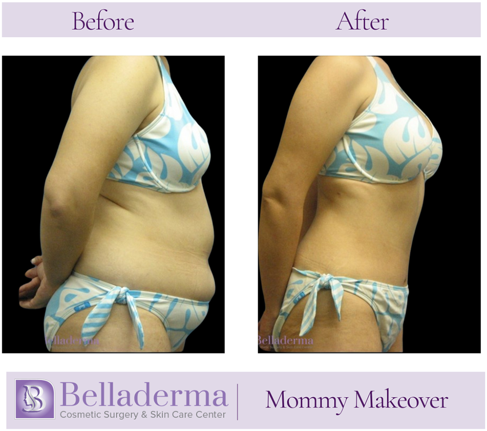 8 Mommy Makeover Before and After