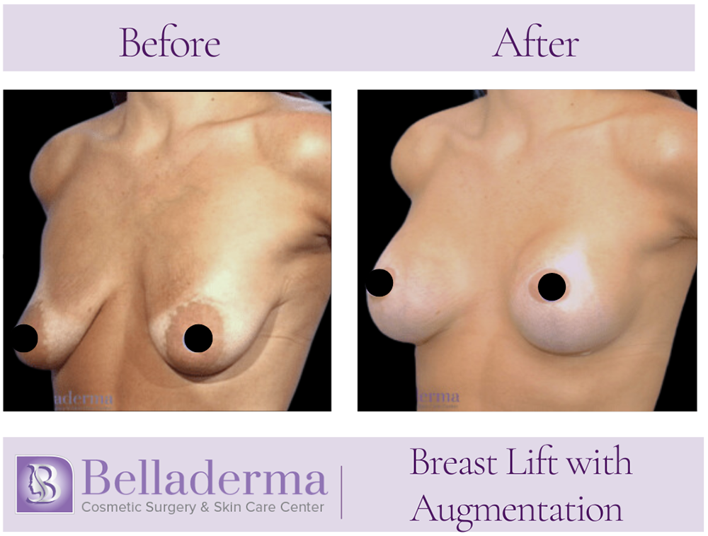 80 Breast Augmentation with Lift Before and After Photos