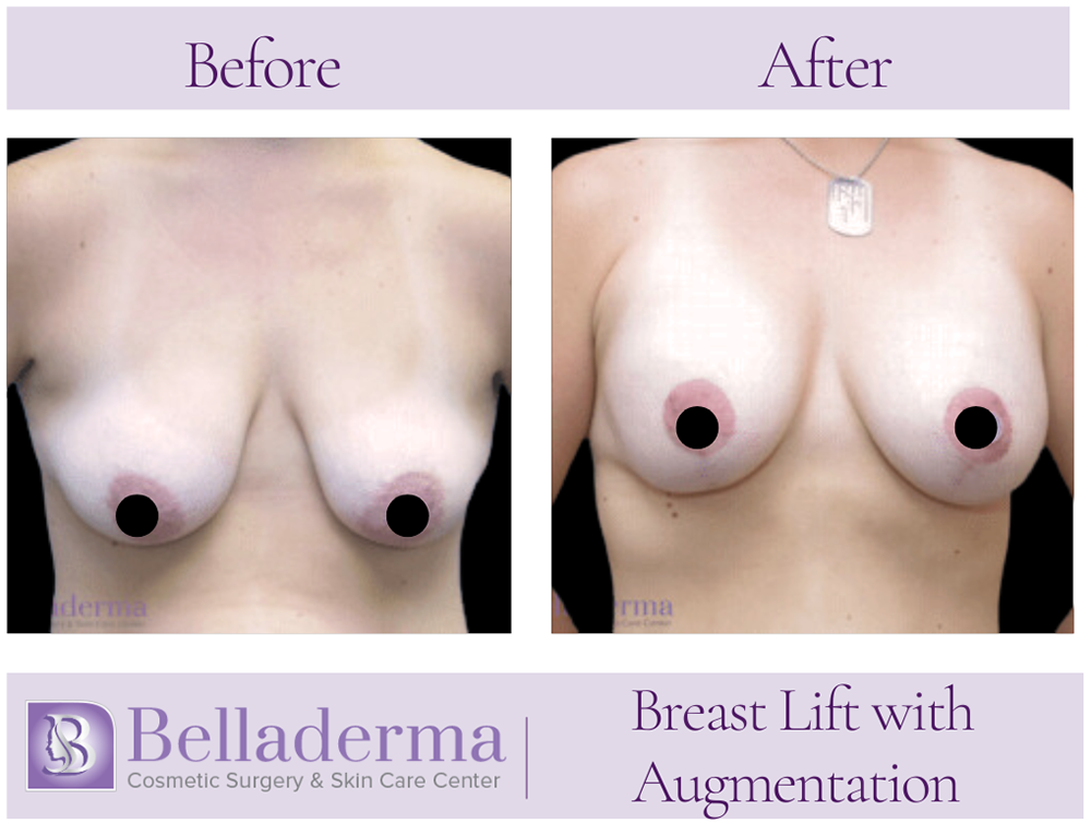 Breast Augmentation with Lift Before and After Photos