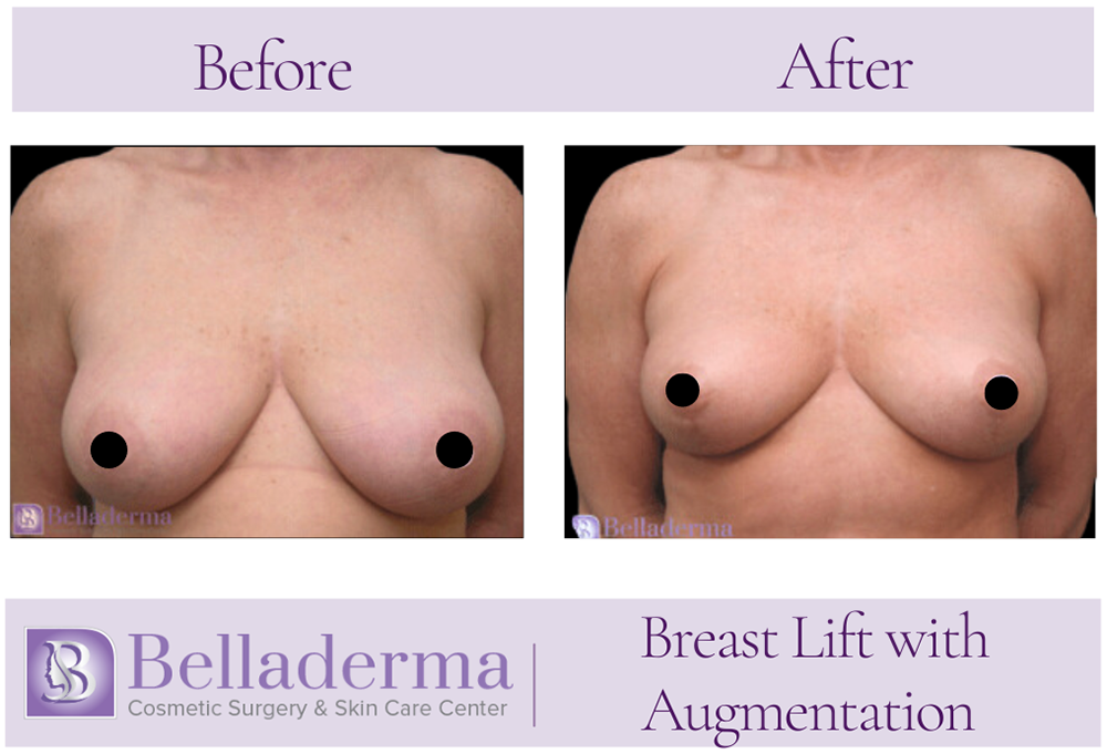 82 Breast Augmentation with Lift Before and After Photos