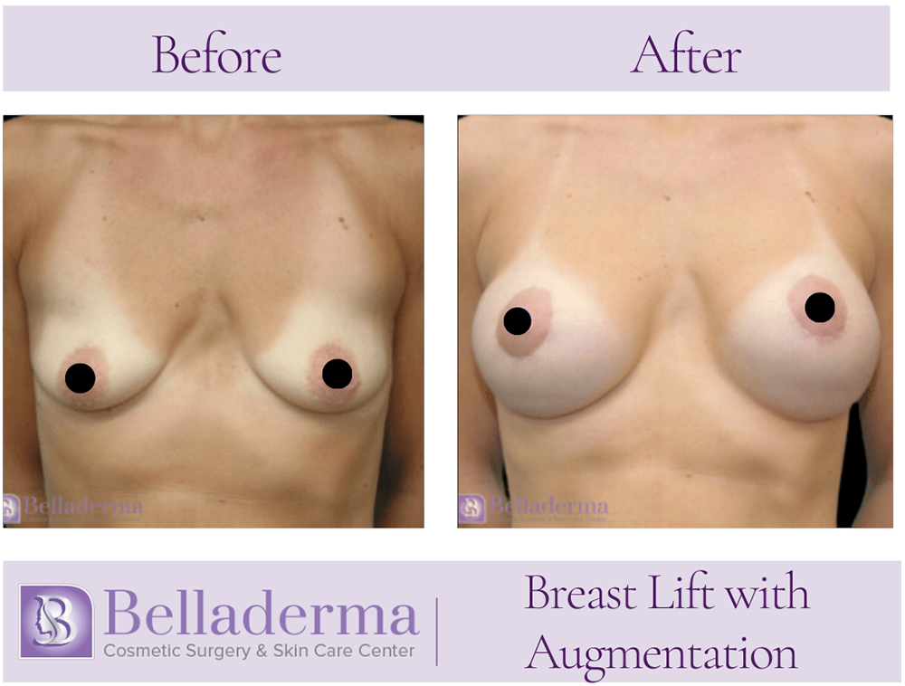 83 Breast Augmentation with Lift Before and After Photos