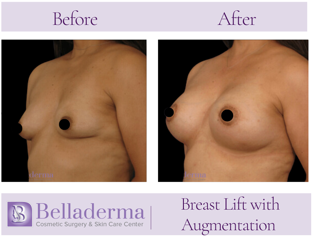 Breast Augmentation with Lift Before and After Photos