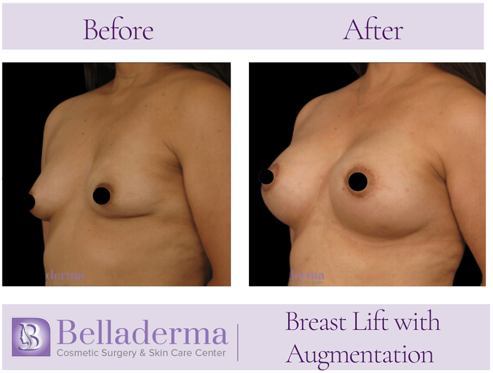 84 Breast Augmentation with Lift Before and After Photos