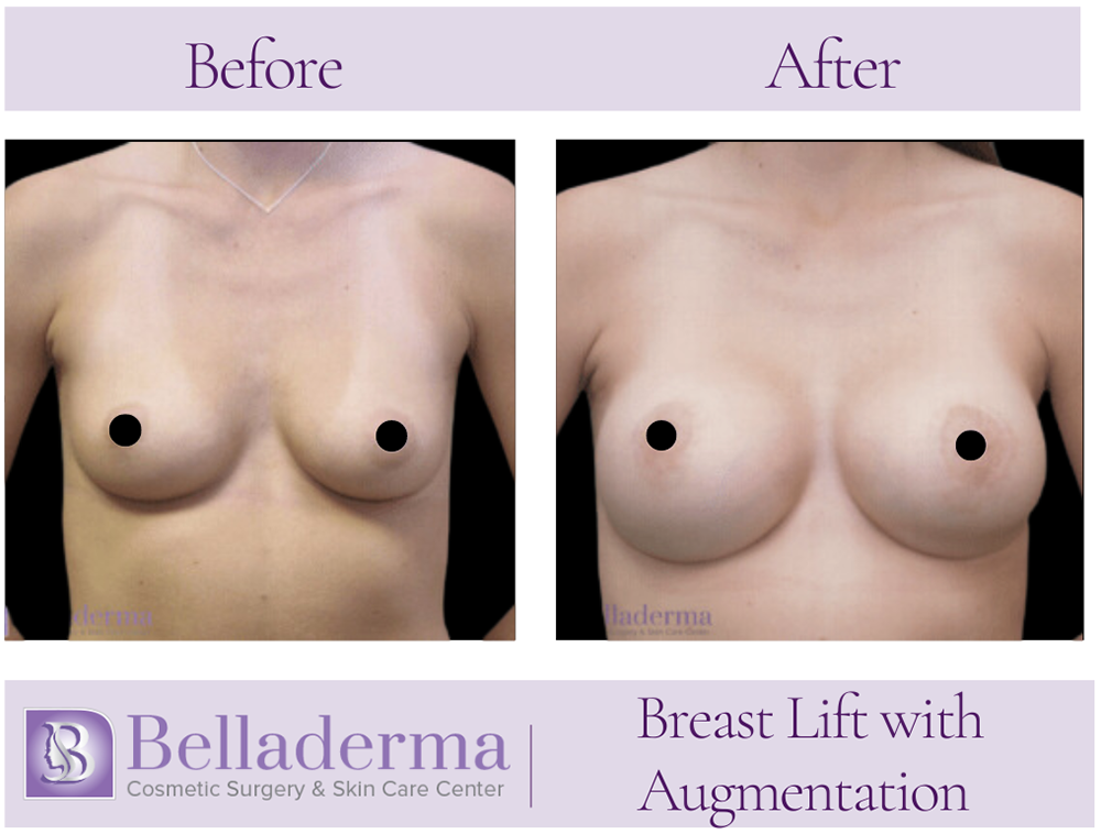 Breast Augmentation with Lift Before and After Photos