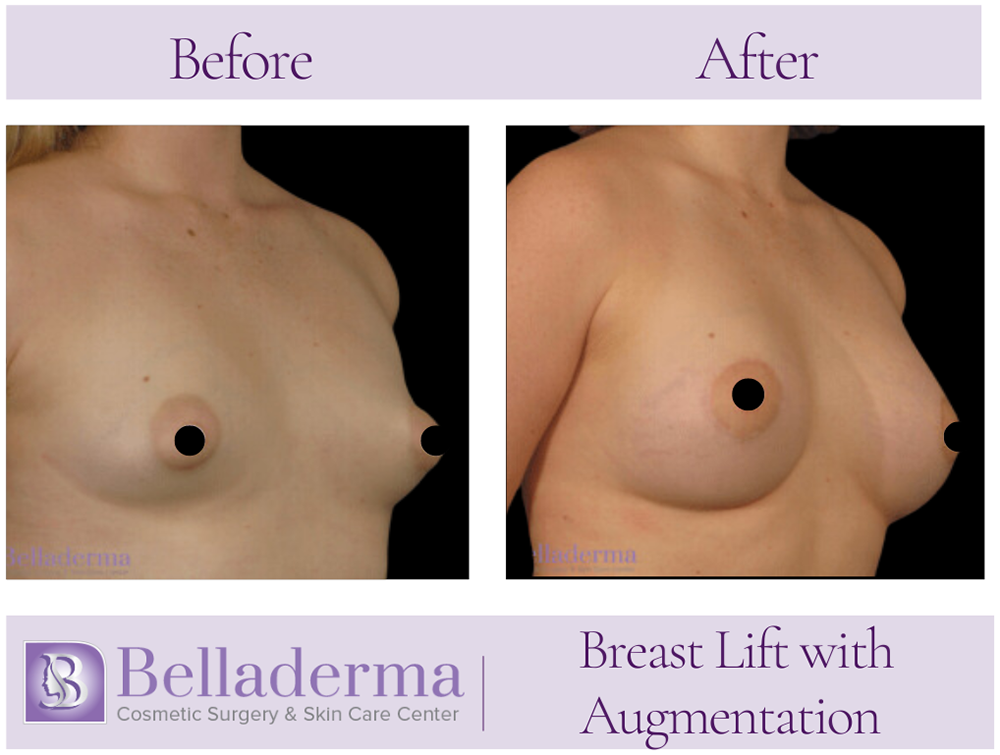 Breast Augmentation with Lift Before and After Photos