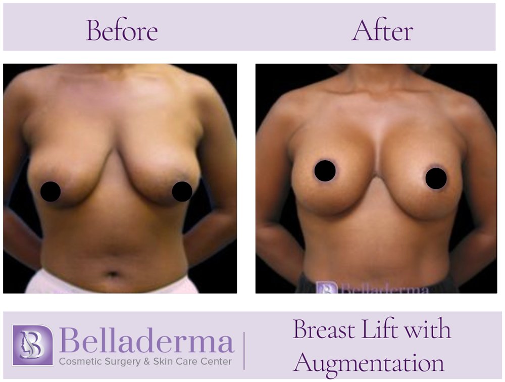 Breast Augmentation with Lift Before and After Photos