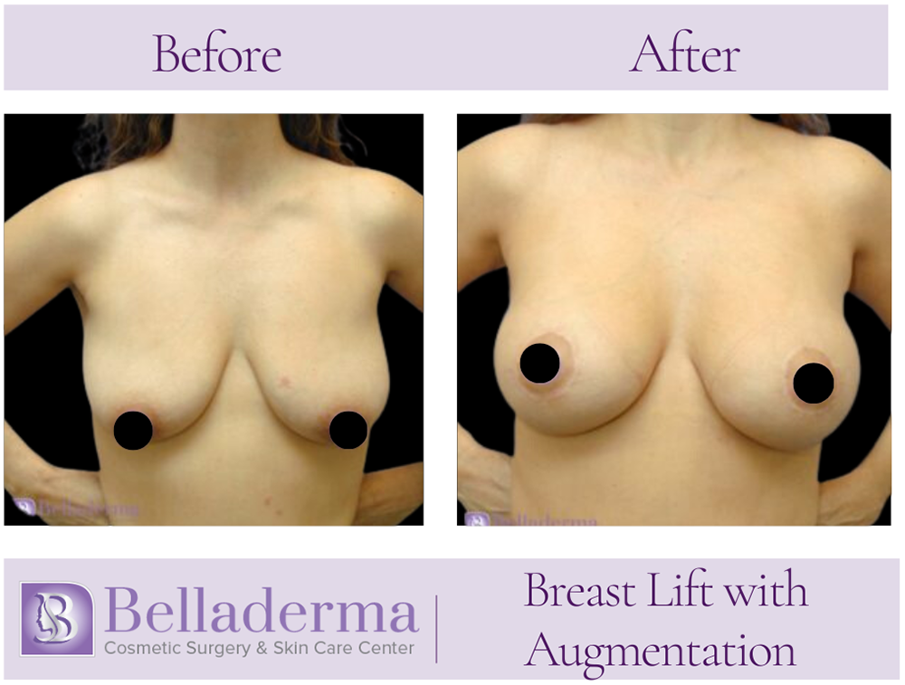 88 Breast Augmentation with Lift Before and After Photos