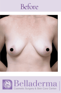 Breast Lift and Augmentation Before and After Pictures in San Diego, CA