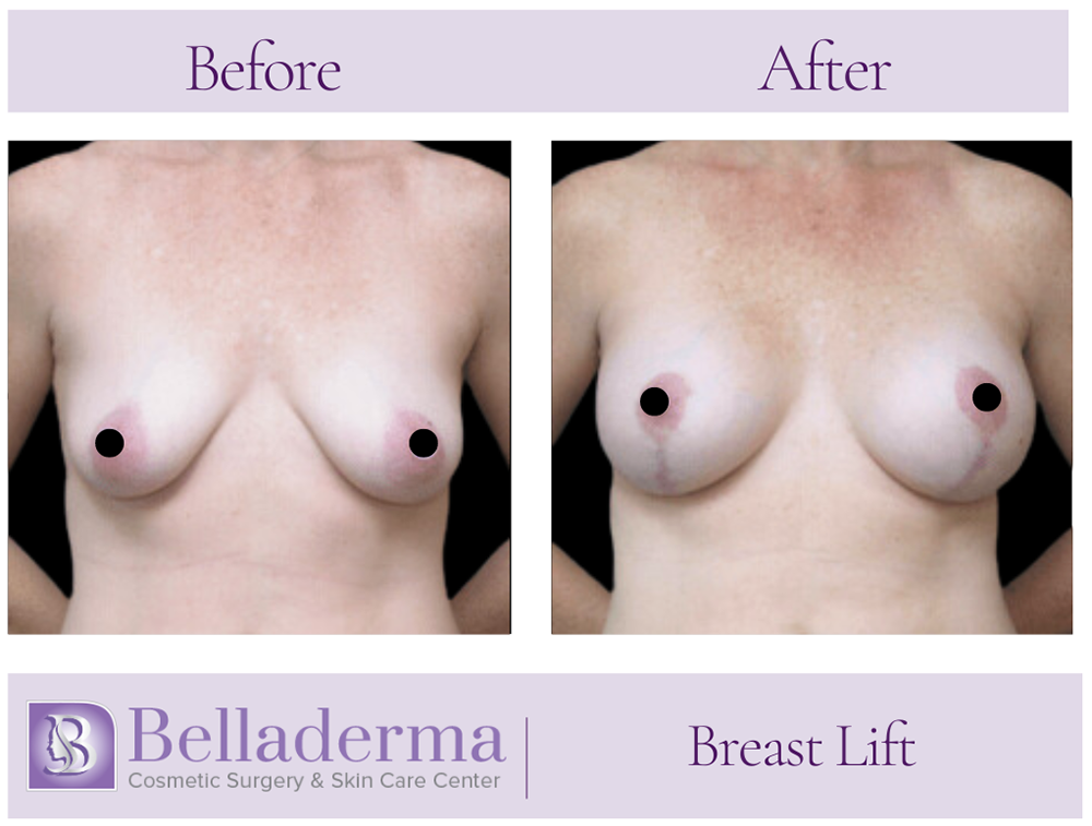 Breast Lift Before and After