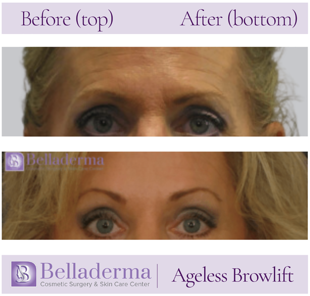 Brow Lift and Eyelid Lift Before and After