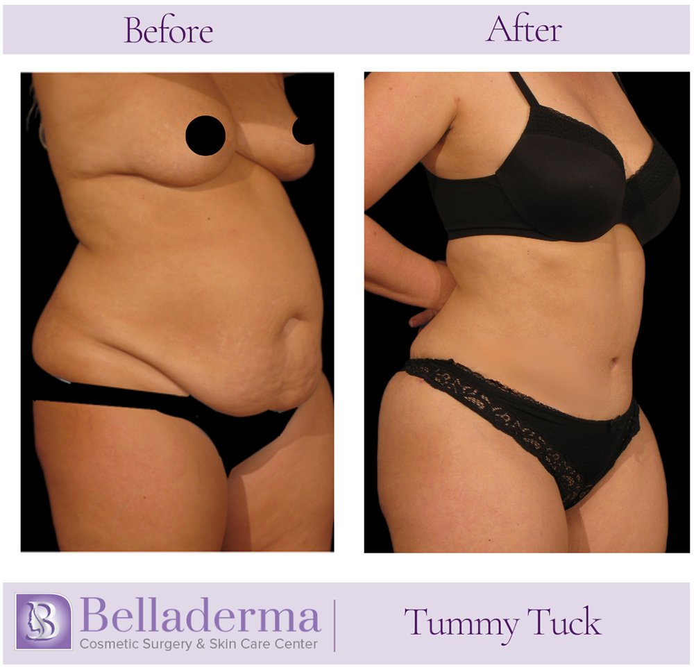 Tummy Tuck (abdominoplasty) Before and After