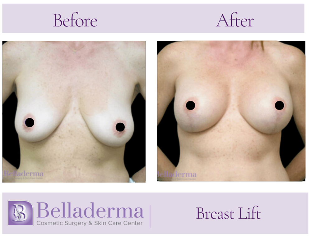 Breast Lift Before and After