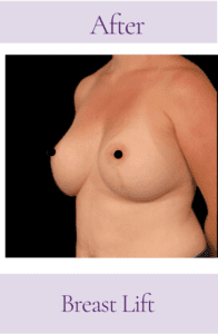 Breast Lift and Augmentation Before and After Pictures in San Diego, CA