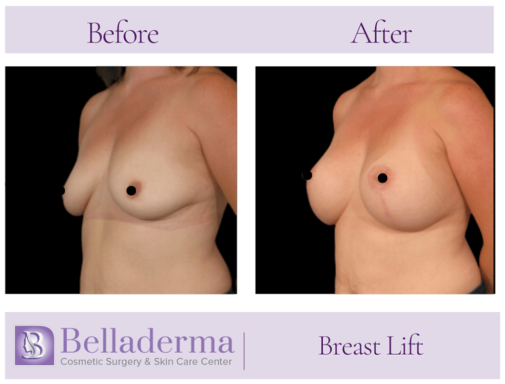 Breast Lift Before and After