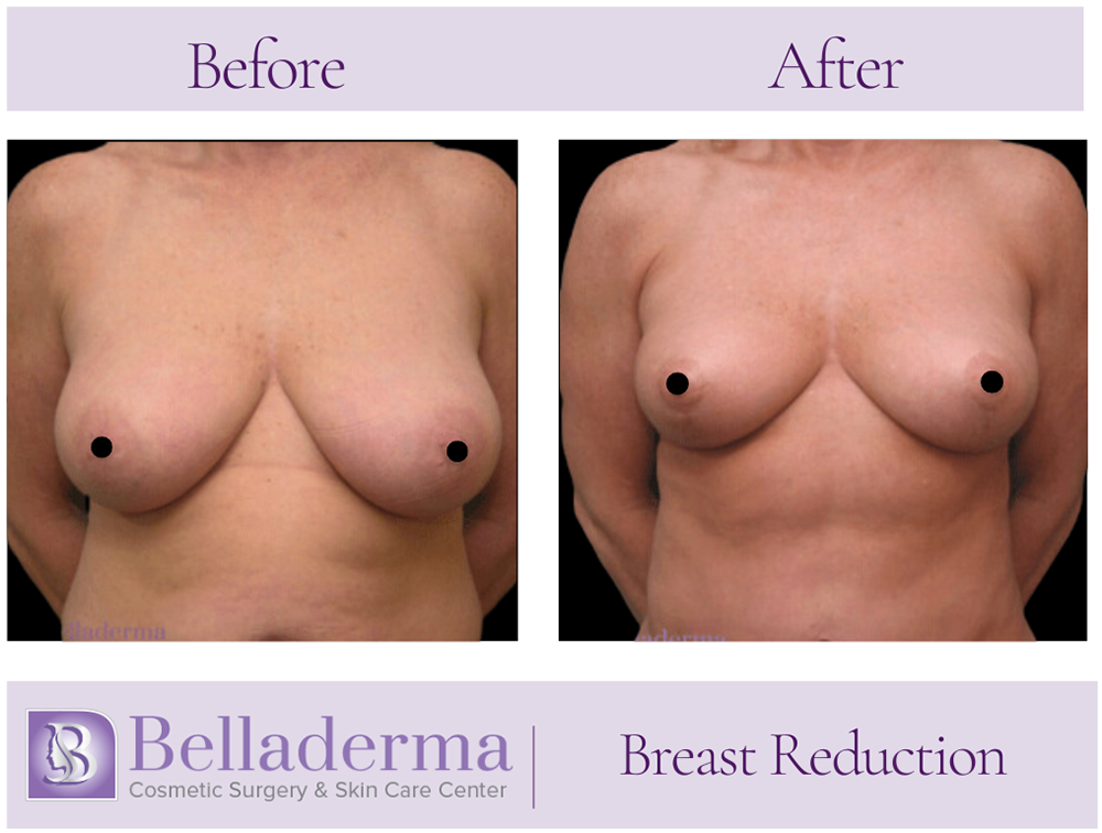 Breast Reduction Before and After