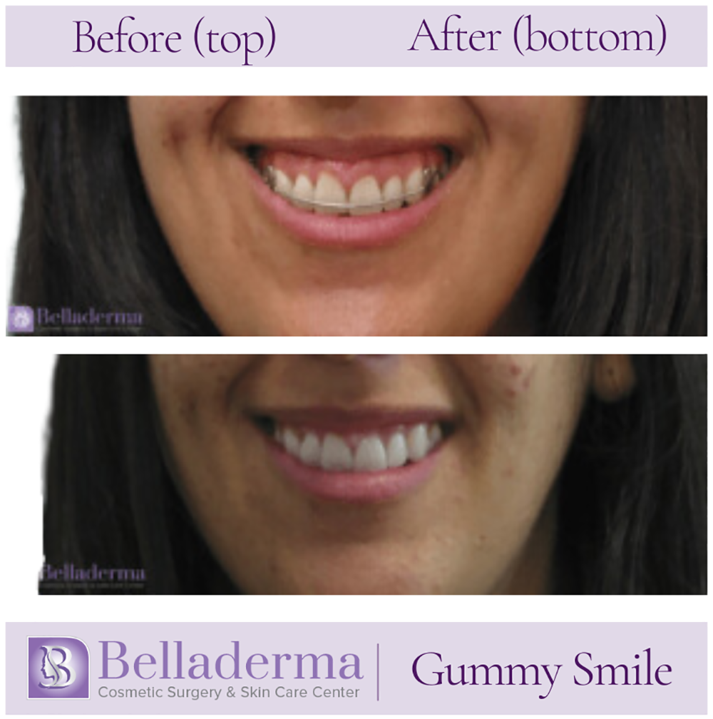 Gummy Smile Before and After