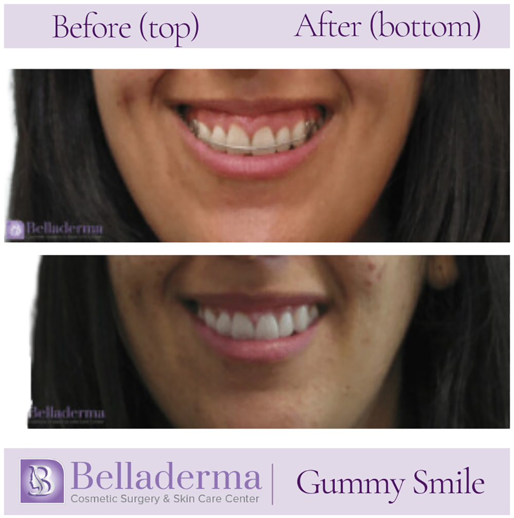 gummysmile website update Gummy Smile Before and After