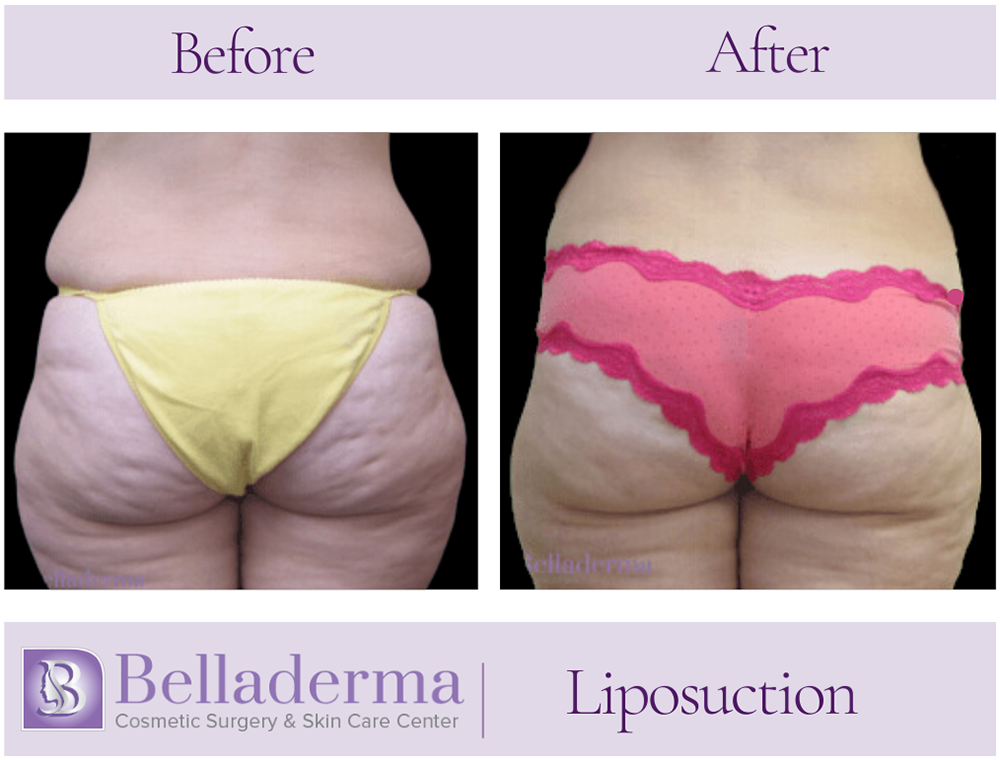 Liposuction Before and After