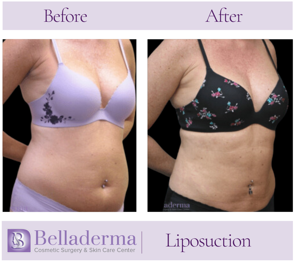 Liposuction Before and After