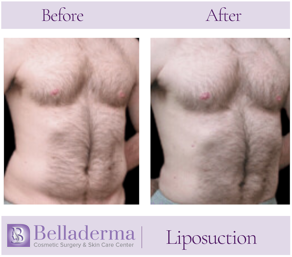 Liposuction Before and After