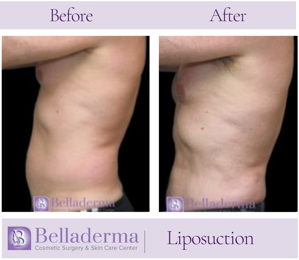 Liposuction Before and After